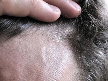 Điều trị bệnh vẩy nến da đầu (Seelp psoviasin)