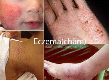 Bệnh Eczema(chàm) là gì?-kien thuc dong y