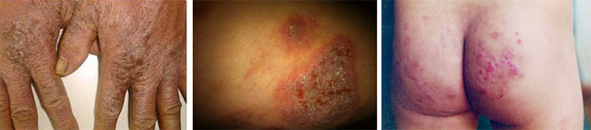 chữa bệnh eczema chàm