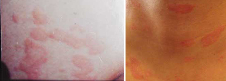 Bệnh dị ứng - bệnh ngoài da