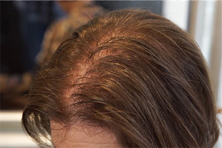 Rụng tóc nhiều - Tình trạng đáng báo động của giới trẻ ngày nay-goc bao chi